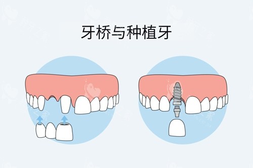 牙冠桥和种植牙对比图 牙冠桥和种植牙对比图