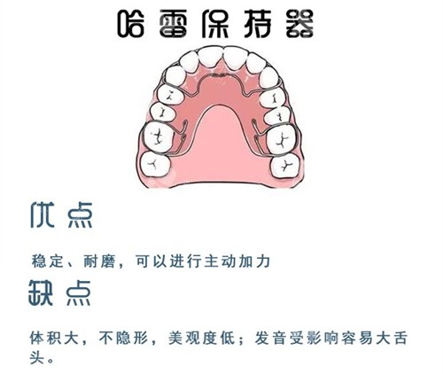 牙齿矫正哈雷保持器.jpg 牙齿矫正哈雷保持器.jpg