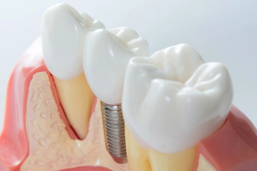 市民询问：九江种植牙多少钱一颗？国产植体3000+/韩系植体4000+/欧洲植体8000+
