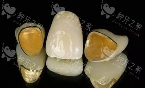 烤瓷牙冠照片