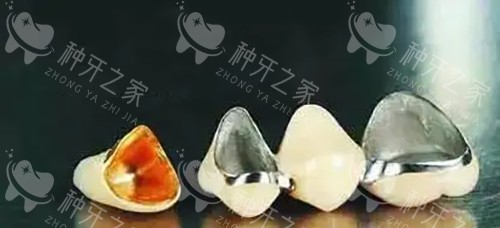 烤瓷牙冠实物示意图