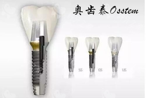 奥齿泰种植牙US系列