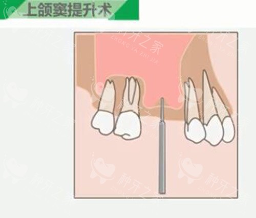 上颌窦提升步骤