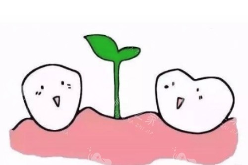 种植牙概念图