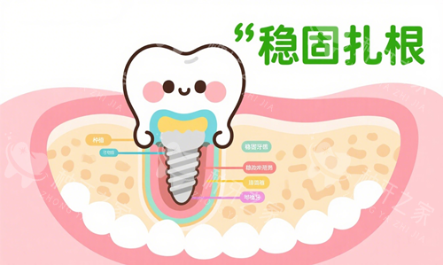 种植牙稳固扎根