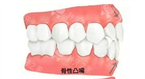 骨性凸嘴
